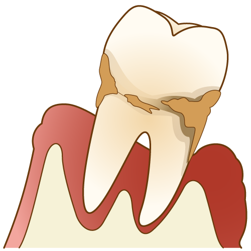 歯周病とは