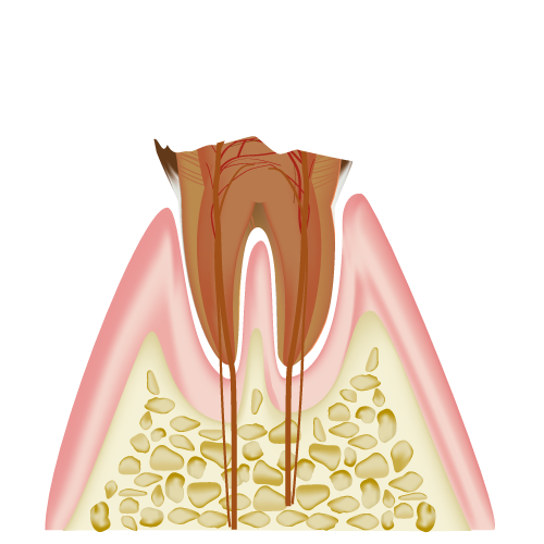 虫歯　C4